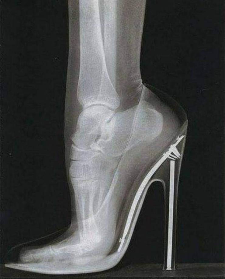 Рентген туфельки