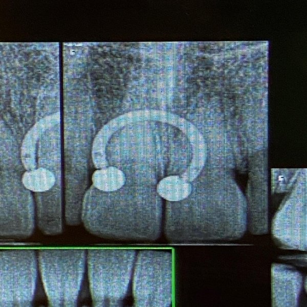 Серёжка для септума видна на рентгеновском снимке зубов